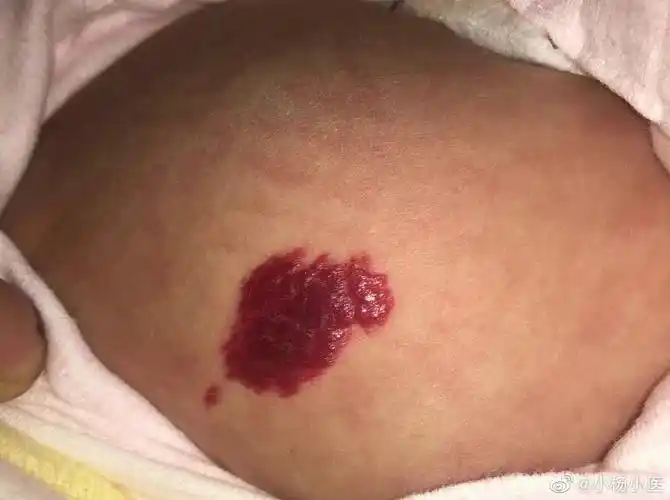 血管瘤_皮肤血管瘤_介绍_症状表现 - 好大夫在线