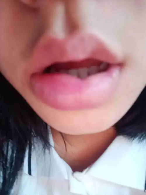 嘴突然就肿了
