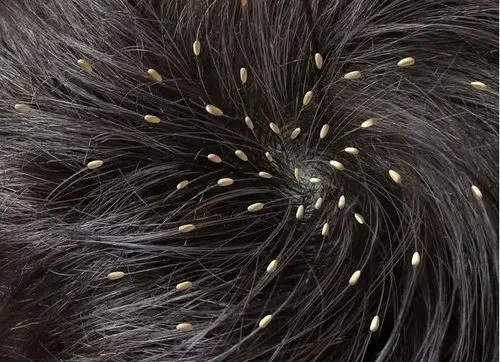 为什么过去困扰农村人的虱子,如今也少见了?原因其实很简单!