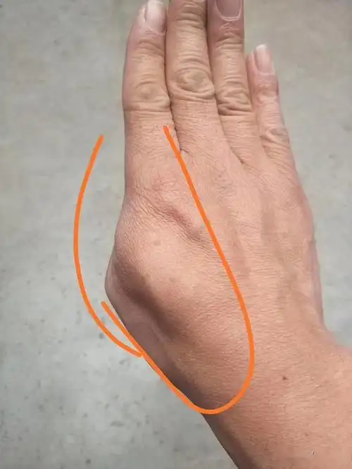 渐冻症即医学上称之为:肌萎缩侧索硬化症,是一种累及损害上,下运动