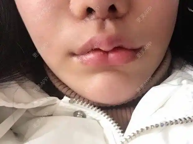 术(轻)】m唇/花瓣唇兔唇/三瓣嘴重庆￥15000起【唇腭裂修复】唇腭裂