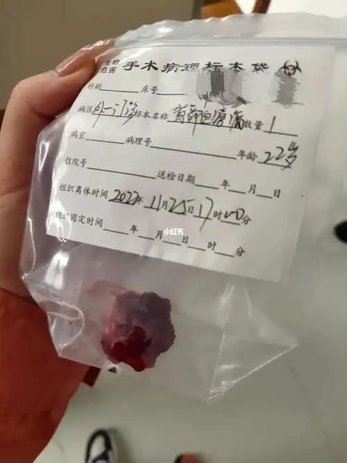 索性就不管了,最近又大又疼,就决定去医院割了,本来以为是脂肪瘤,医生