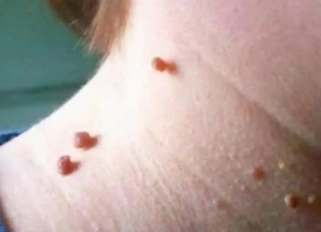 从临床上来说,尖锐湿疣的形状表现有乳头状菜花状鸡冠状等,所以hpv