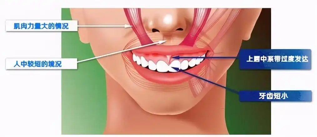 ps:引起露龈笑的原因有很多,有可能是由颌骨,面部软组织结构异常,上唇