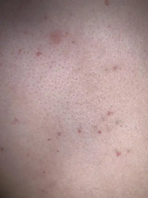 皮肤上出现红点