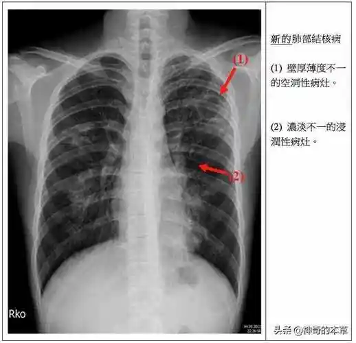 原发型肺结核典型x线表现为肺内原发灶,淋巴管炎和肿大的肺门或纵膈
