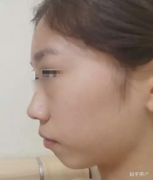 侧脸很平啊怎么办啊感觉脸就是一条线下去了特别丑眼睛近视还突嘴也突