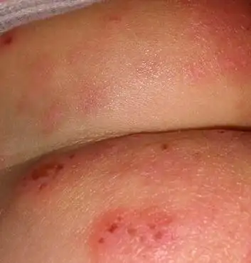 性病阴虱的症状图片