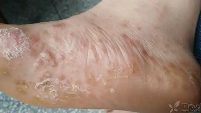 女 双足底足背散在多发性丘水疱疹伴瘙痒脱屑一周 足趾缝脱屑红斑