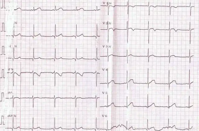 心室颤动,引起严重血流动力学障碍而需要立即电复律或电除颤等治疗的