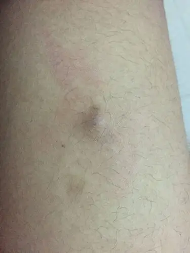 皮肤前几个月起了一个包 后面被我挤了 现在 硬硬的