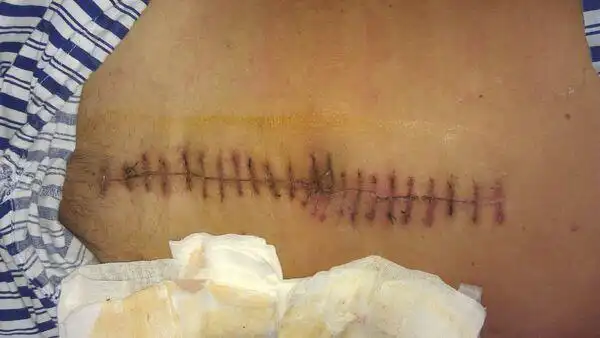 腹腔镜parks手术在低位直肠癌保肛手术的优势