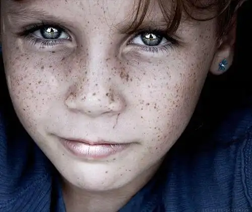 脸部的晒斑,雀斑要这么淡