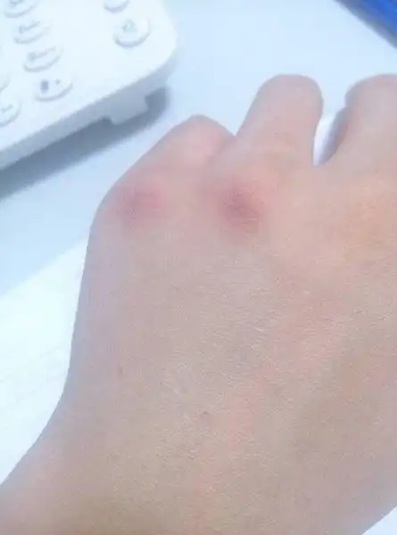 针孔周围都是青的.