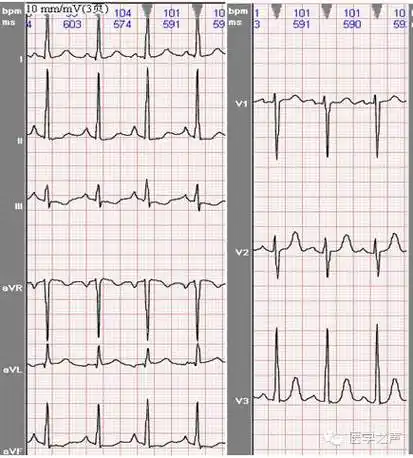 心电图课堂|第4期:左室肥大