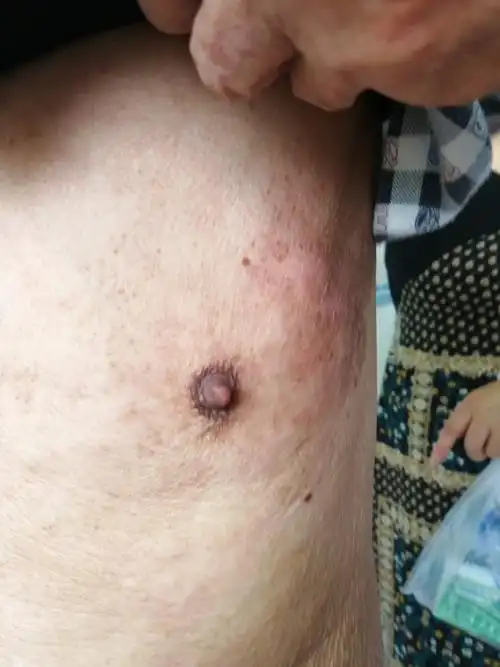 生殖性疱疹潜伏期(女性生殖疱疹潜伏期症状) - 医药经