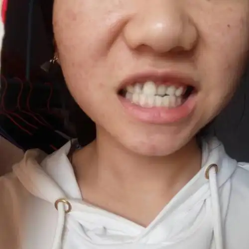 牙齿不整齐,有什么办法可以使牙齿整齐?