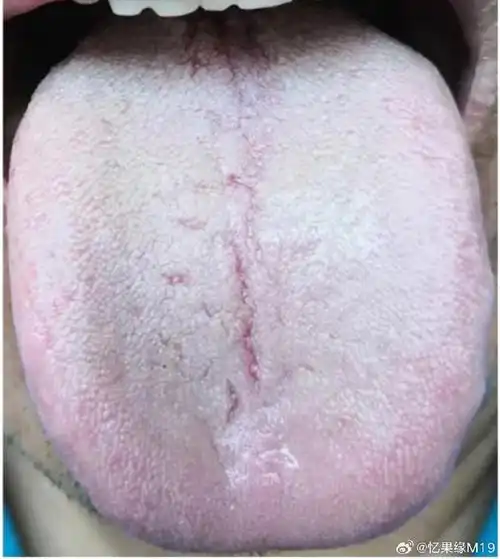 水,看起来很湿,同时还有齿痕,整个舌头的颜色是淡白的,舌苔也比较白