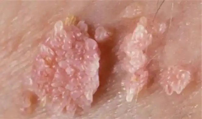 包括男性尿道口,龟头,冠状沟,包皮及系带,阴囊,阴茎体及阴茎根部等