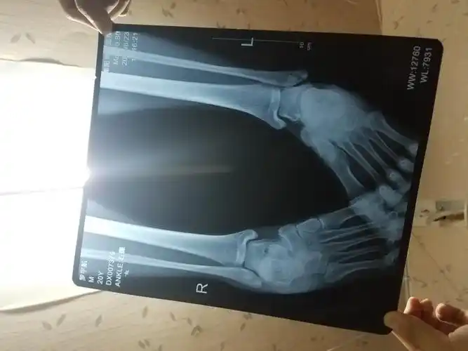 求看一看有没有骨折?