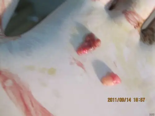 肛裂肛瘤外痔内痔粘膜内脱垂术前术后图片欣赏