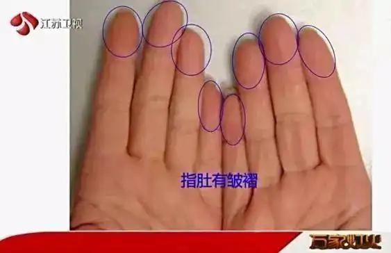此外,正常手指的指肚应该是特别饱满的,如果手指指肚出现干瘪和皱褶