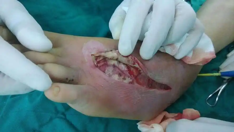 眼镜蛇咬伤致皮肤软组织坏死溃疡治疗体会