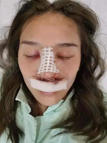 鼻综合整形术后1天_垫鼻尖术后1天_垫鼻基底术后1天_鼻型矫正术后1天