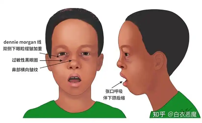 第二节:腺样体肥大有哪些危害?腺样体面容是怎么样的? - 知乎