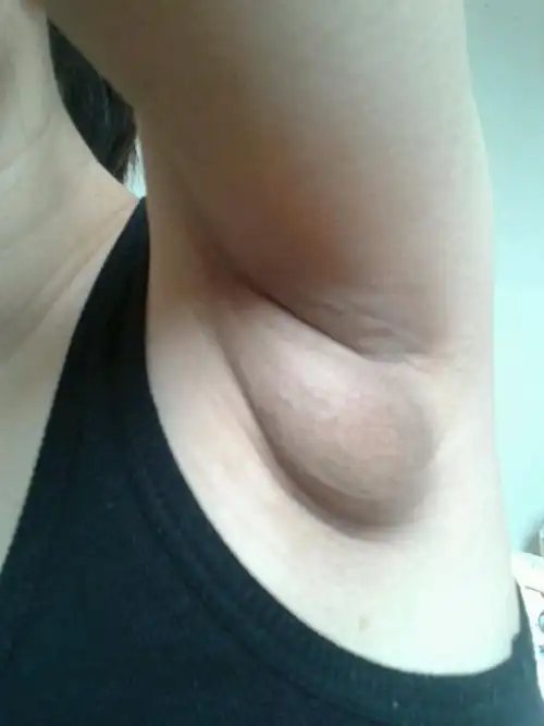 接种卡介苗竟然引发腋下淋巴肿大结核肿瘤_有来医生