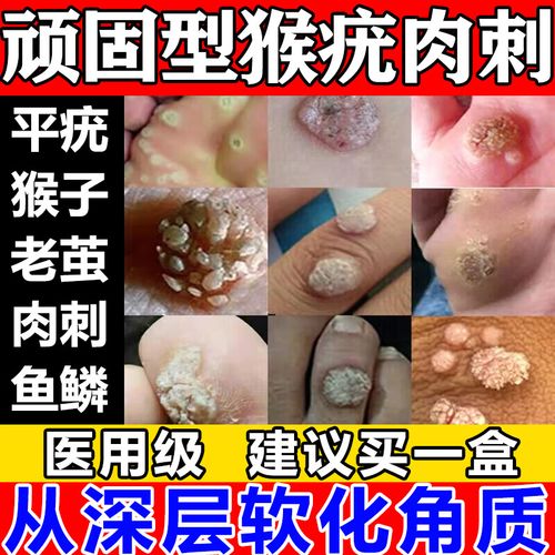维a酸乳膏 扁平疣药膏 去猴子扁平疣专用药 全身各种疣体瘊子肉粒小