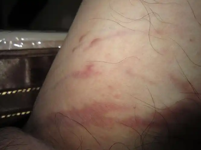 以前有过湿疹,是湿疹还没好吗?