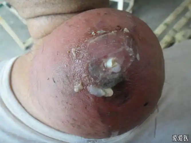 看图诊断50皮脂腺囊肿粉瘤