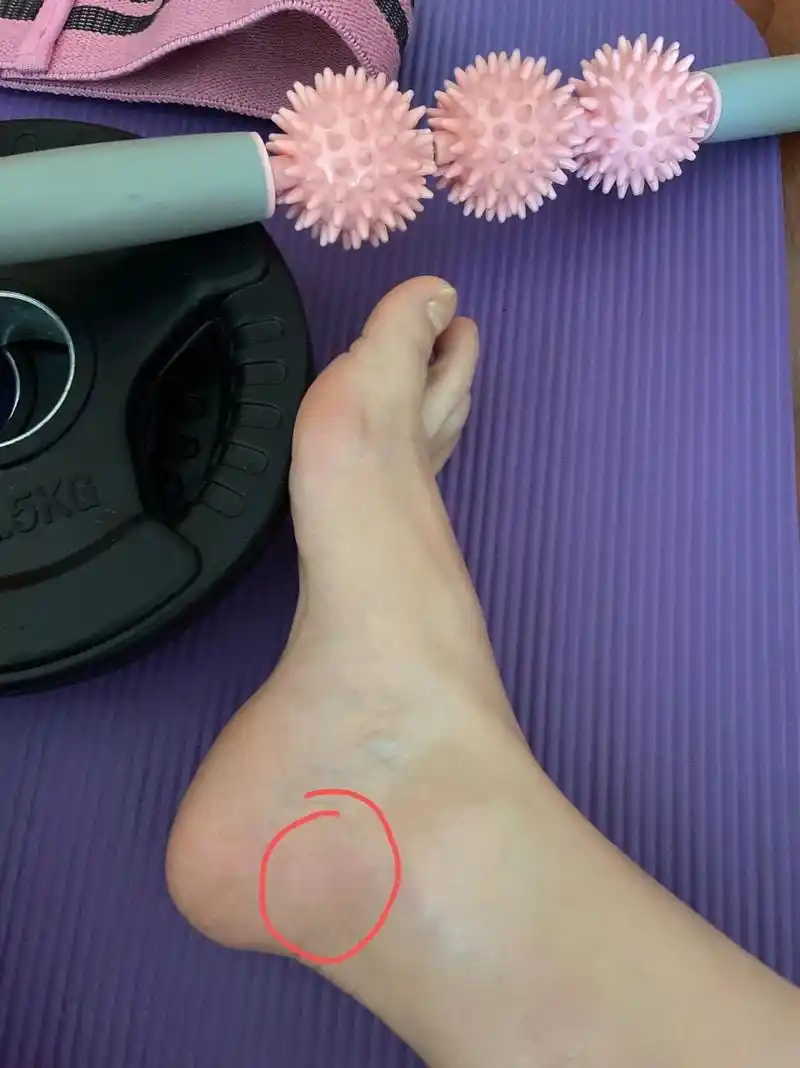 运动完脚踝内侧疼 连续运动一个月 这两天脚裸处突然疼痛 有没有小