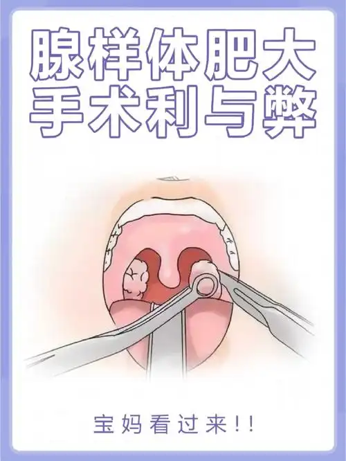 腺样体肥大手术利与弊宝妈看过来60