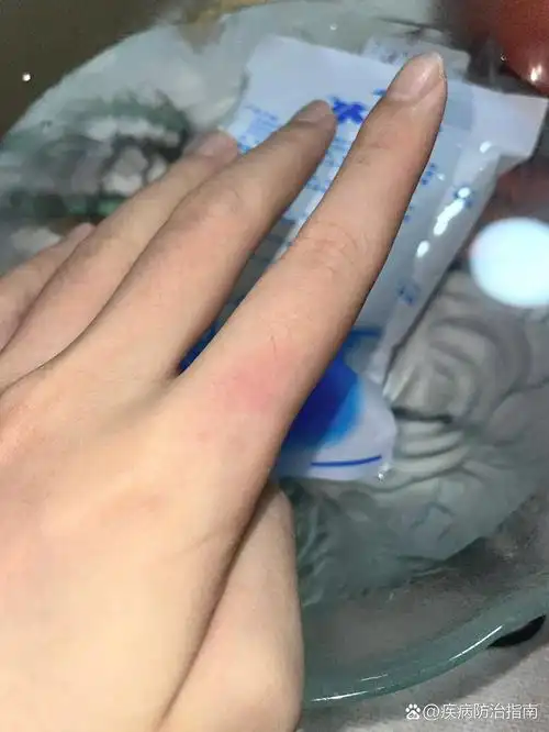 日常烫伤处理经验 之前有几年经常不注意被烫伤,处理多了都成习惯了