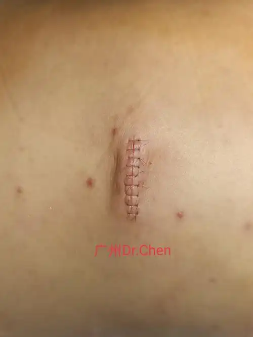 脂肪瘤切除精细美容缝合_脂肪瘤_脂肪瘤治疗方式 - 好大夫在线