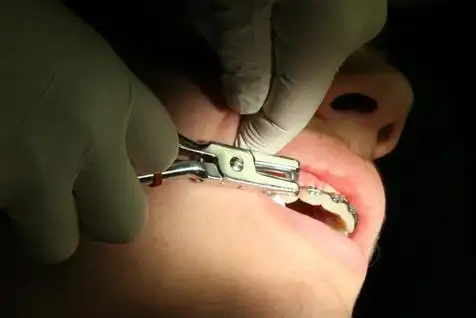 无痛拔牙多少钱呢?