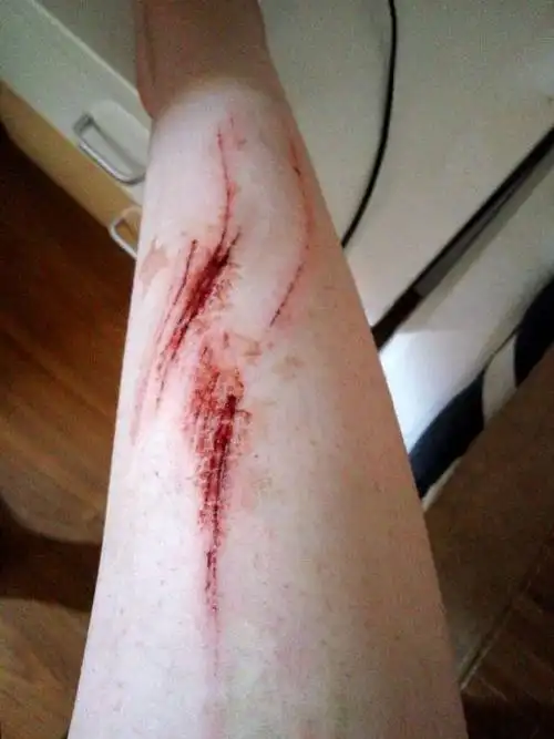 骑自行车被摔了小腿被划了很多条长长的口子 怎么处理这种情况