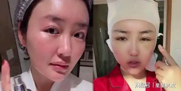 下巴脸颊凹陷,鼻子透光,明明是整容后遗症,却嘴犟说天生丽质|杨紫