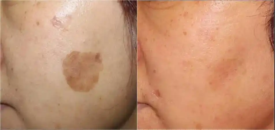 一般来说,经过 2-3次的治疗,可使表面光滑,长斑地方的颜色会更