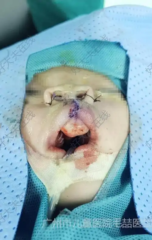 双侧唇裂_唇腭裂 - 好大夫在线