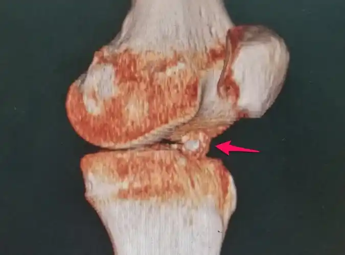 年轻女性膝前交叉韧带胫骨端撕脱粉碎骨折,膝关节肿痛,伸直障碍