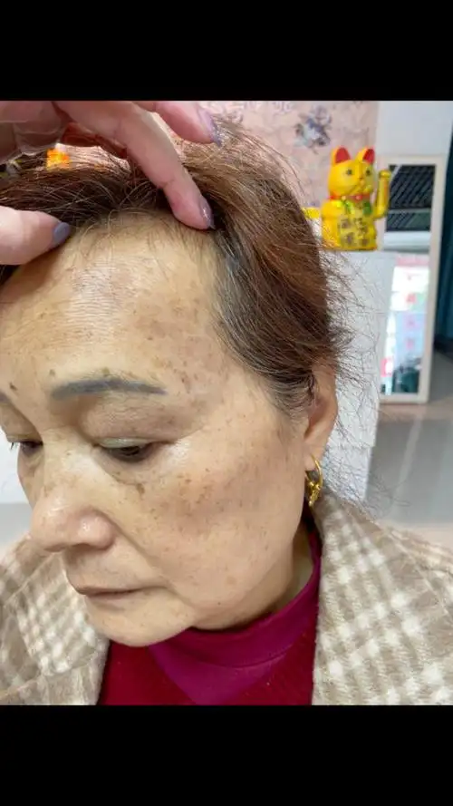 重度真皮斑,两次技术后的对比照片,这样的照顾还行吗?