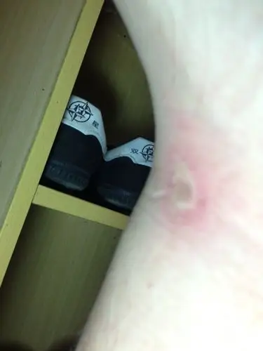 请问这是什么虫咬的,它自己会消吧.