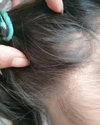 万能的盐友们,谁知道好的治头上虱子的办法啊,女儿头上长了一头的虱子