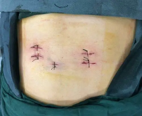 其它 经脊柱内镜下融合术治疗Ⅲ度腰椎滑脱并峡部裂 写美篇手术历时3