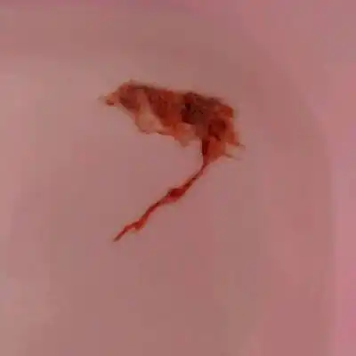 了三天药,23号早上吃了3片米索前列醇,24号早上才排出很像孕囊的东西