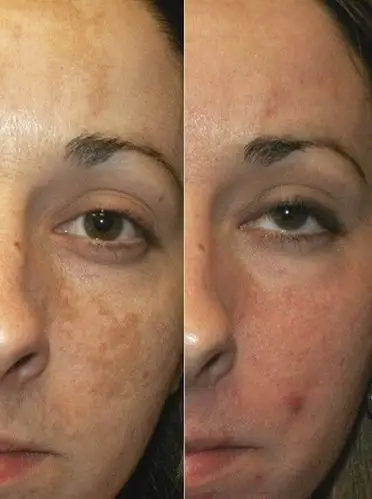 妊娠斑图片 (1)_有来医生