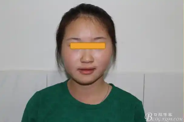 一例成人下颌偏斜正畸案例